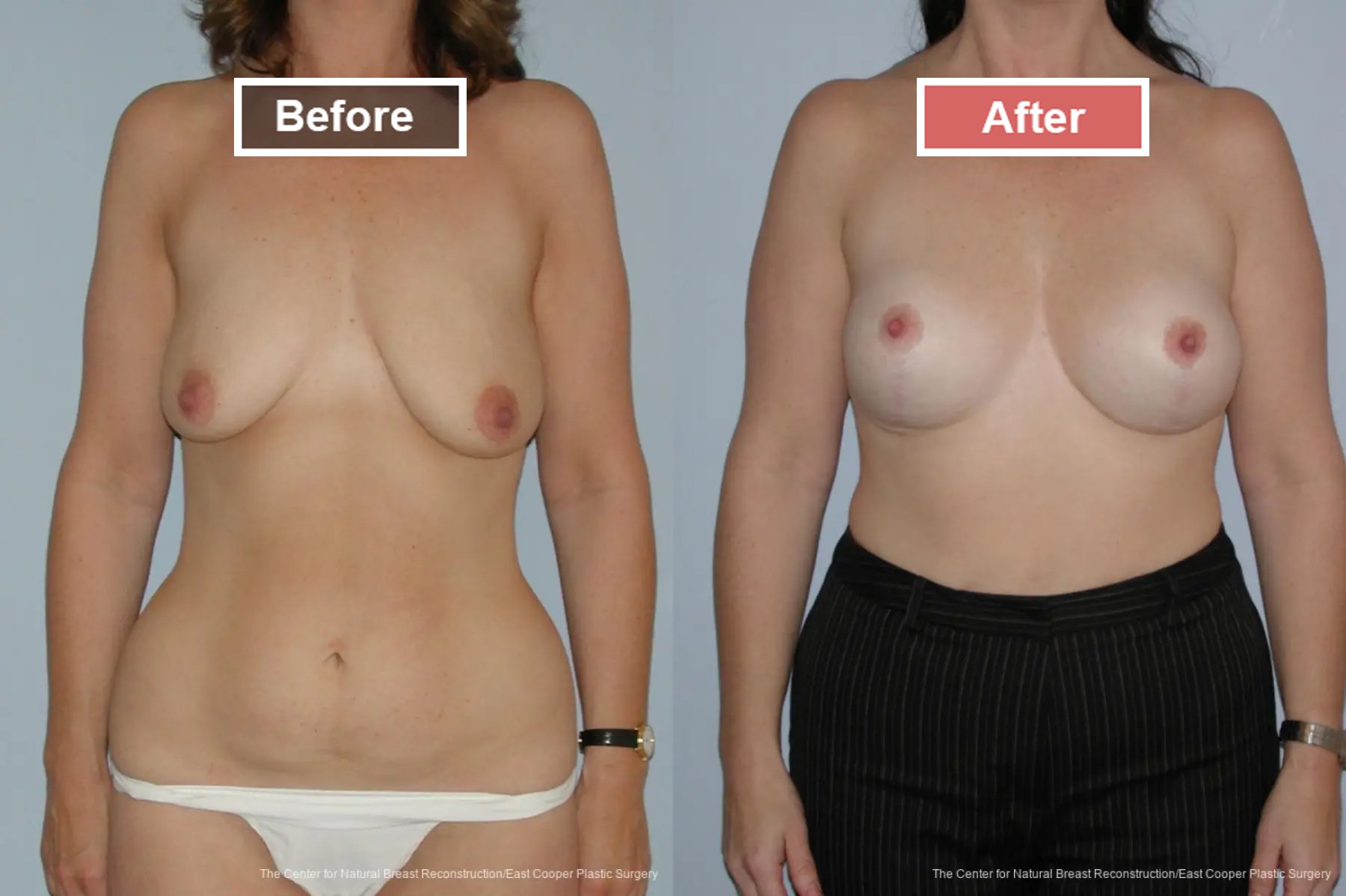 Breast Augmentation treatment before and after - 11