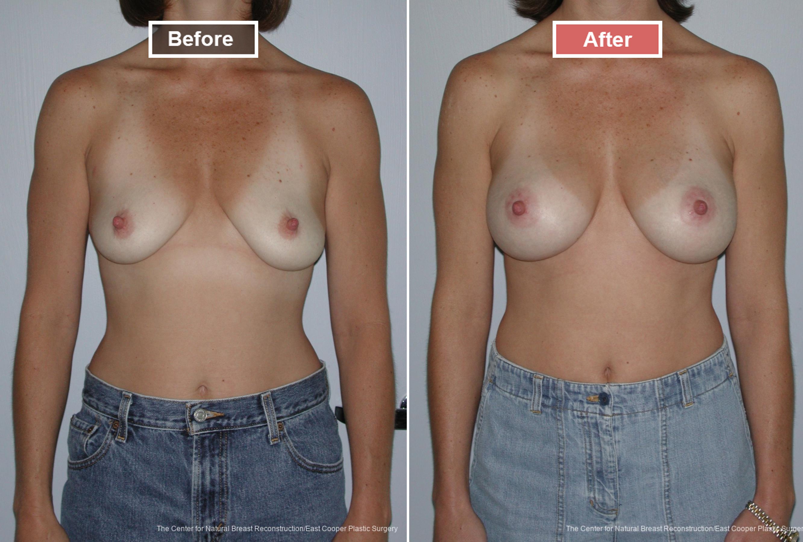 Breast Augmentation treatment before and after - 12