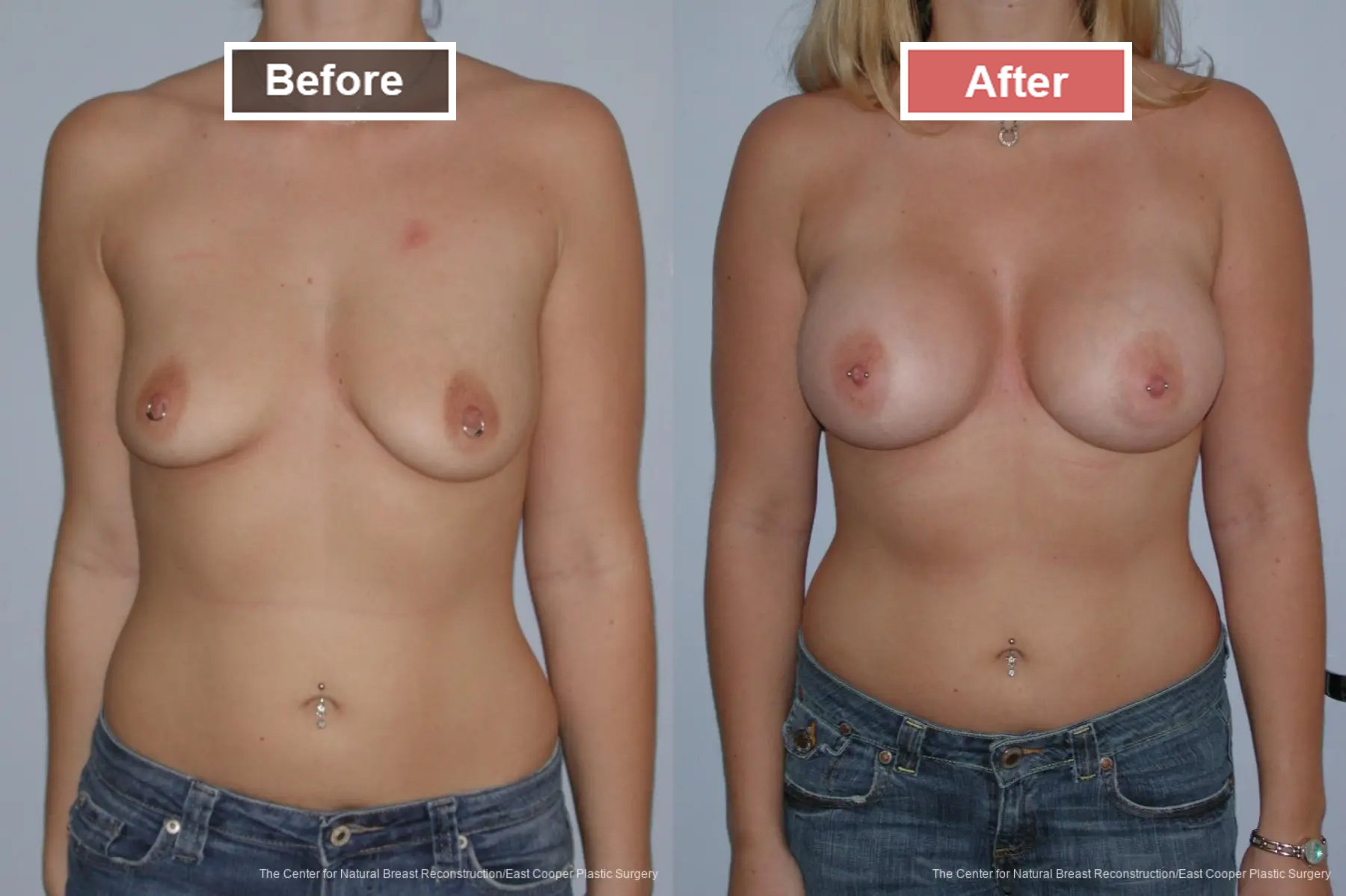 Breast Augmentation treatment before and after - 13