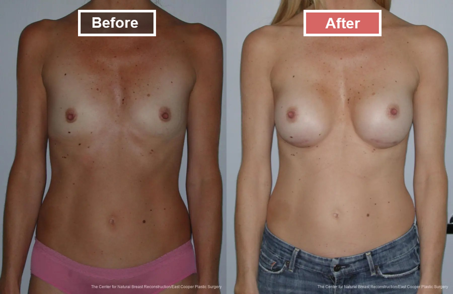 Breast Augmentation treatment before and after - 14
