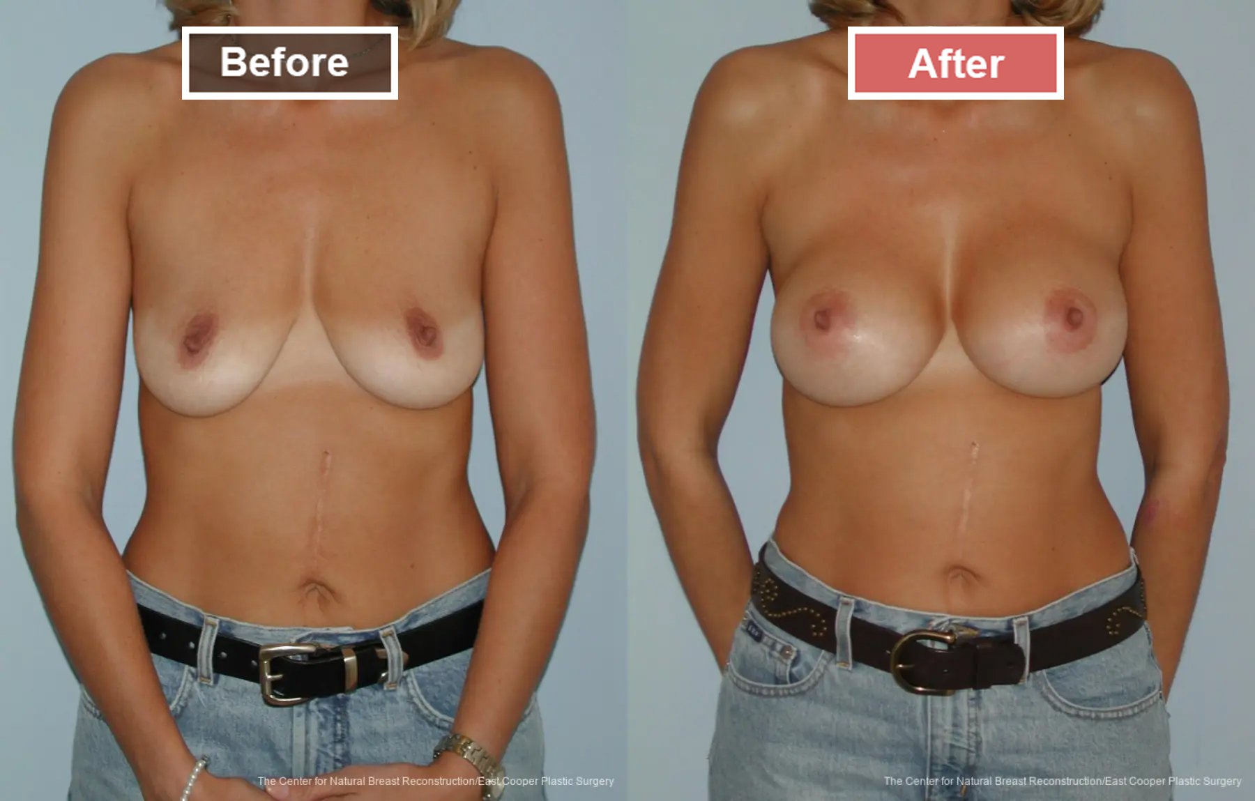 Breast Augmentation treatment before and after - 15