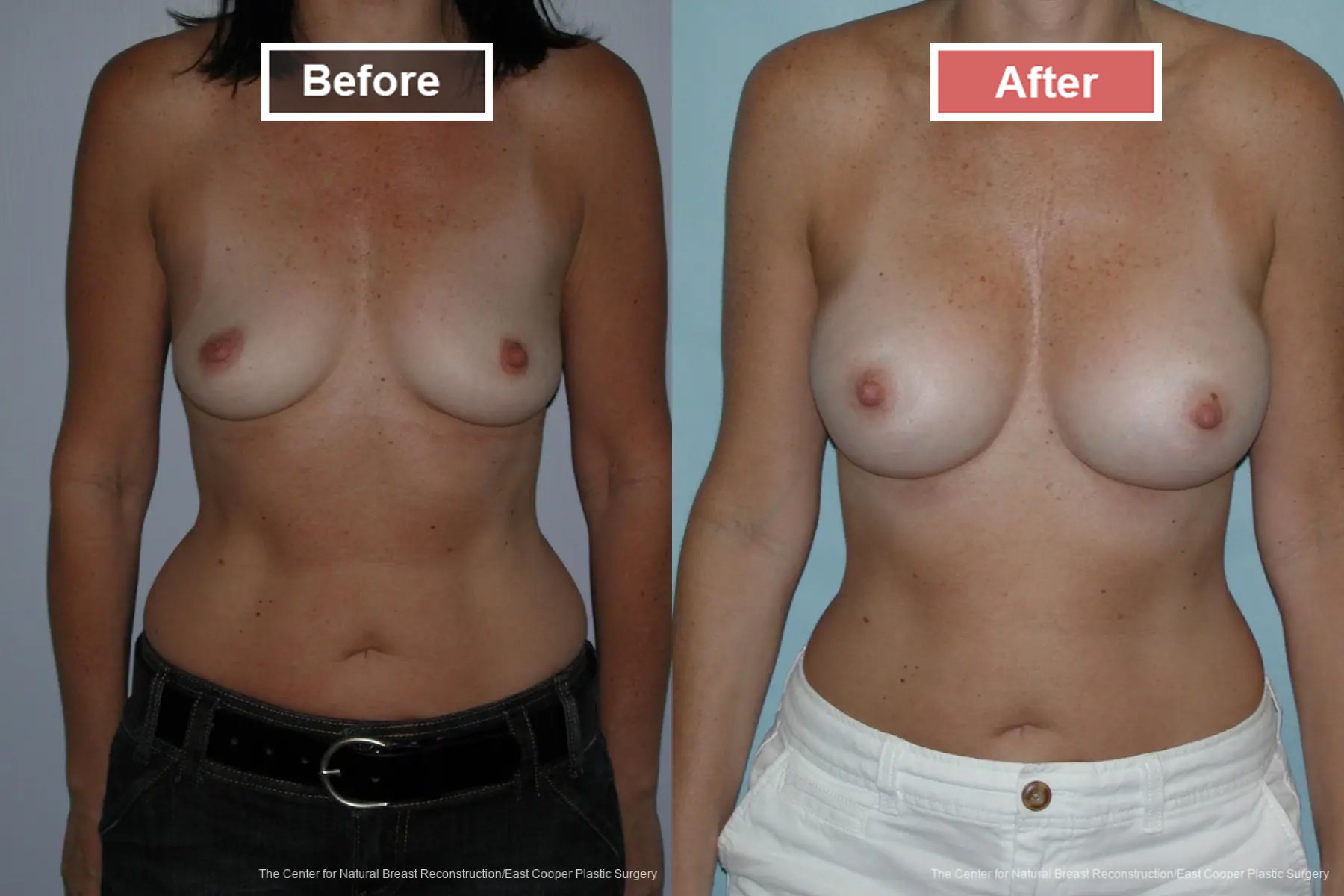 Breast Augmentation treatment before and after - 17