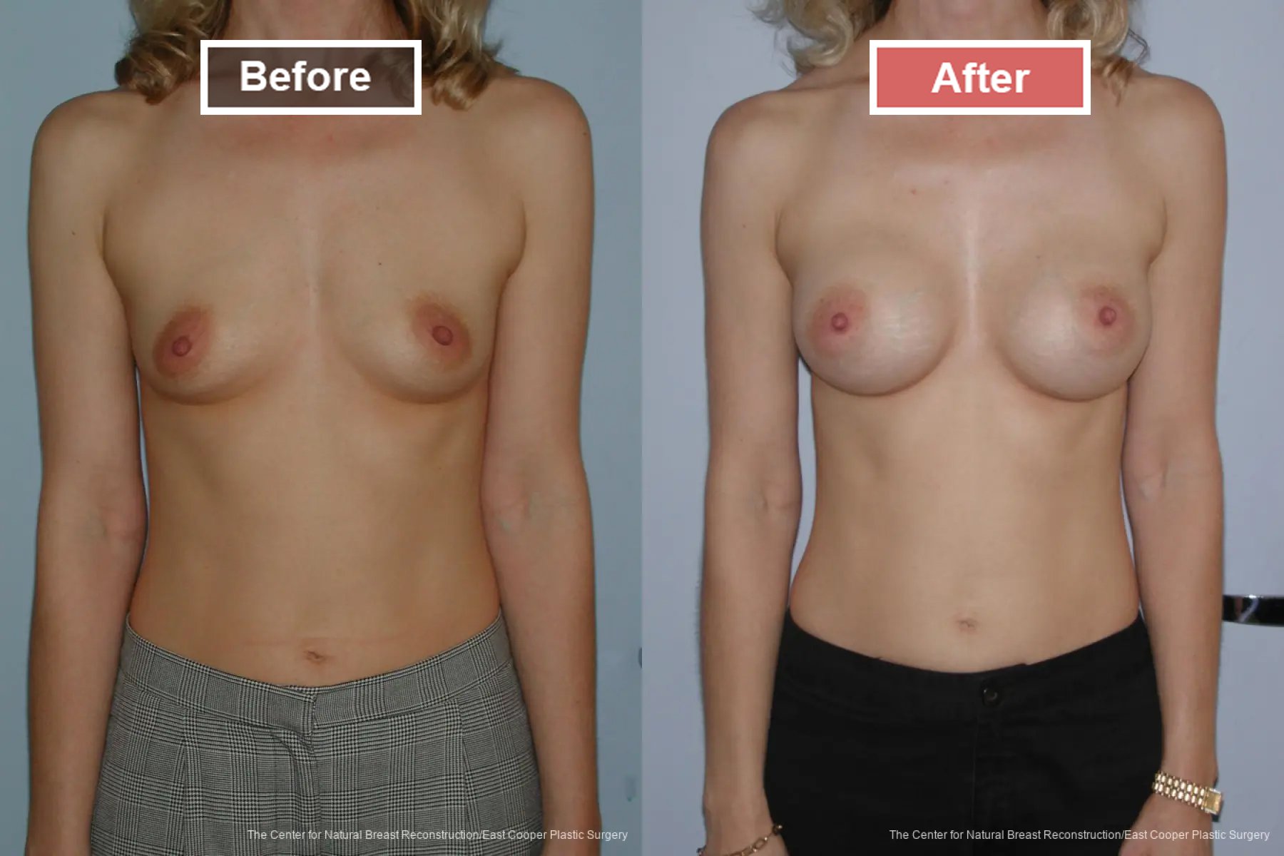 Breast Augmentation treatment before and after - 18