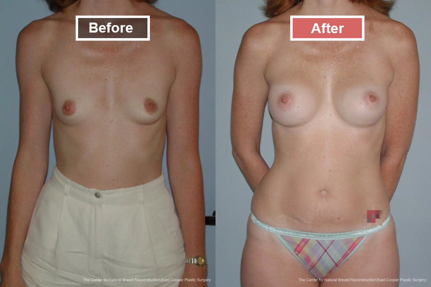 Breast Augmentation treatment before and after - 19