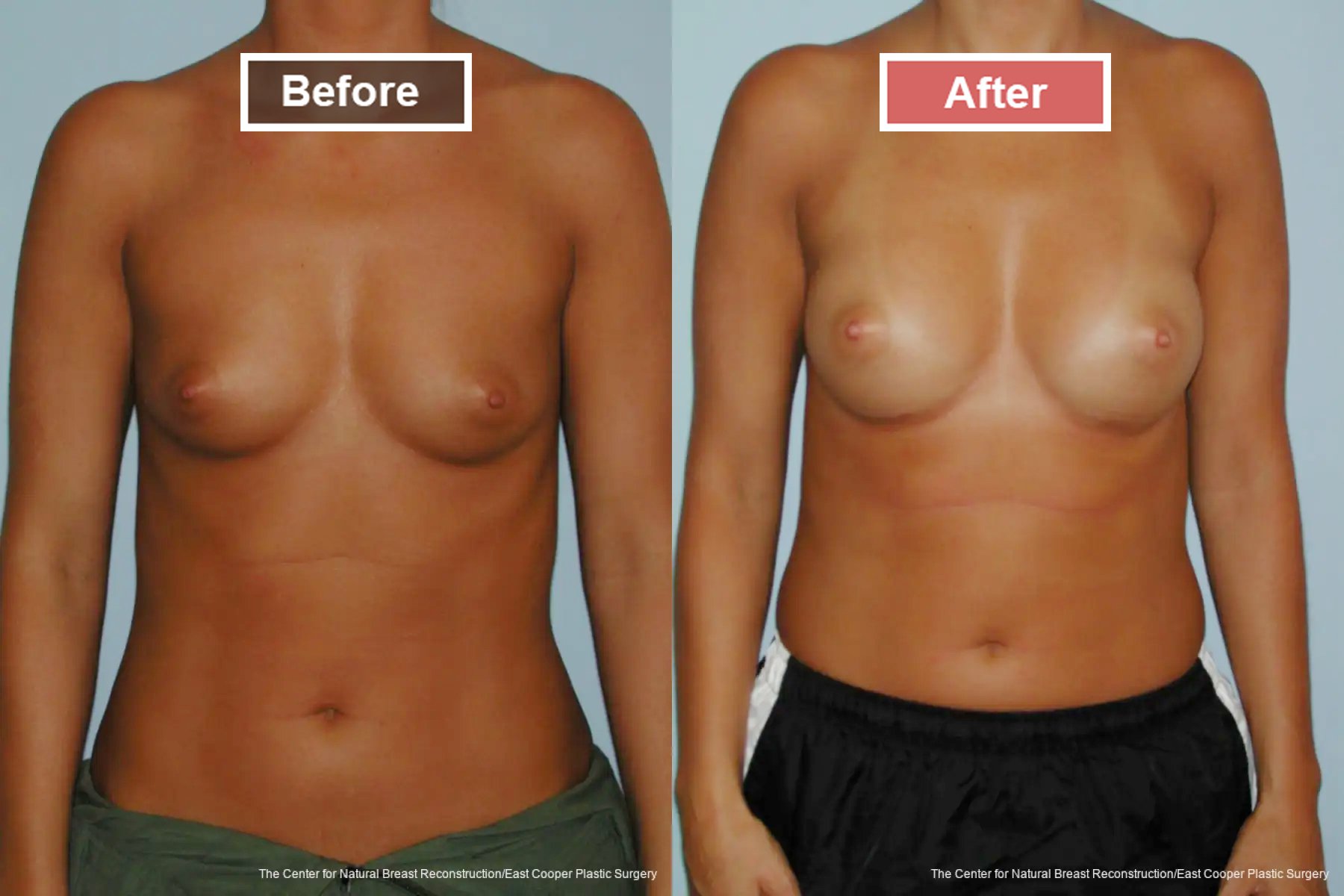 Breast Augmentation treatment before and after - 20