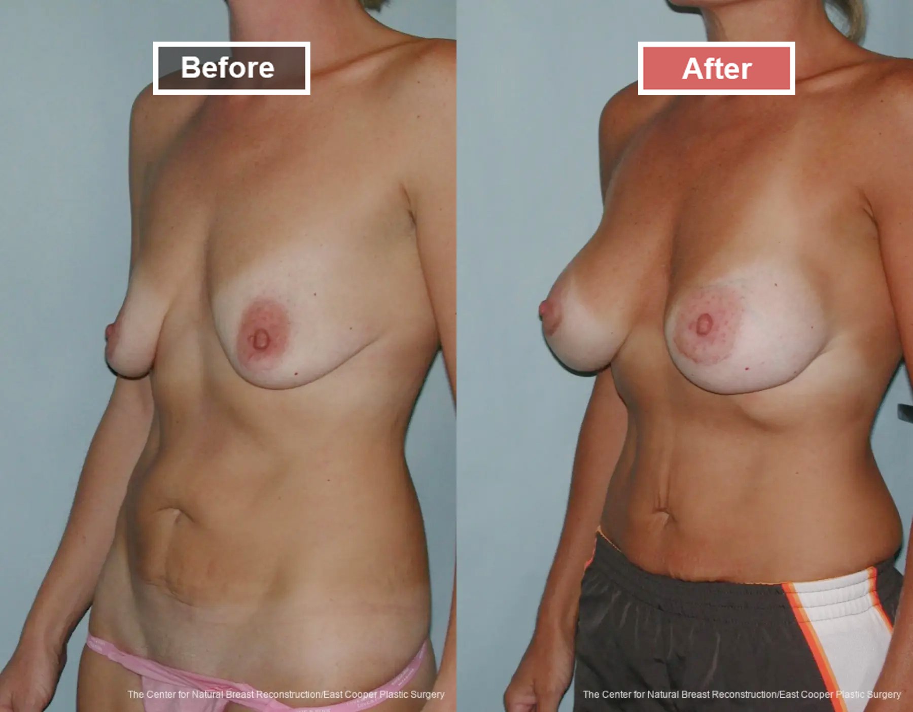 Breast Augmentation treatment before and after - 21