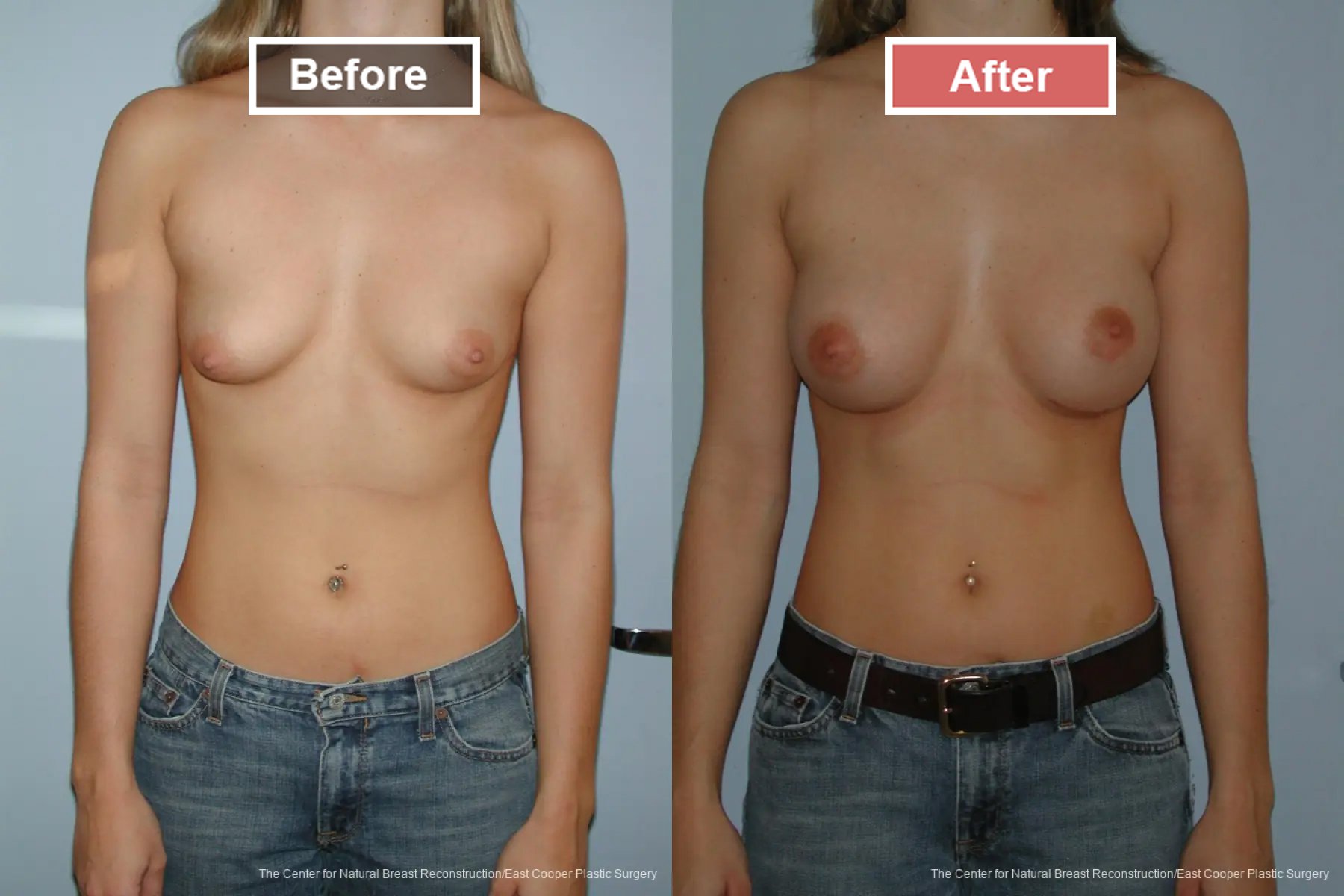 Breast Augmentation treatment before and after - 22
