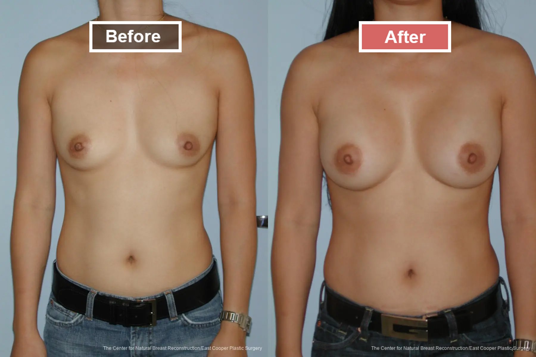 Breast Augmentation treatment before and after - 23