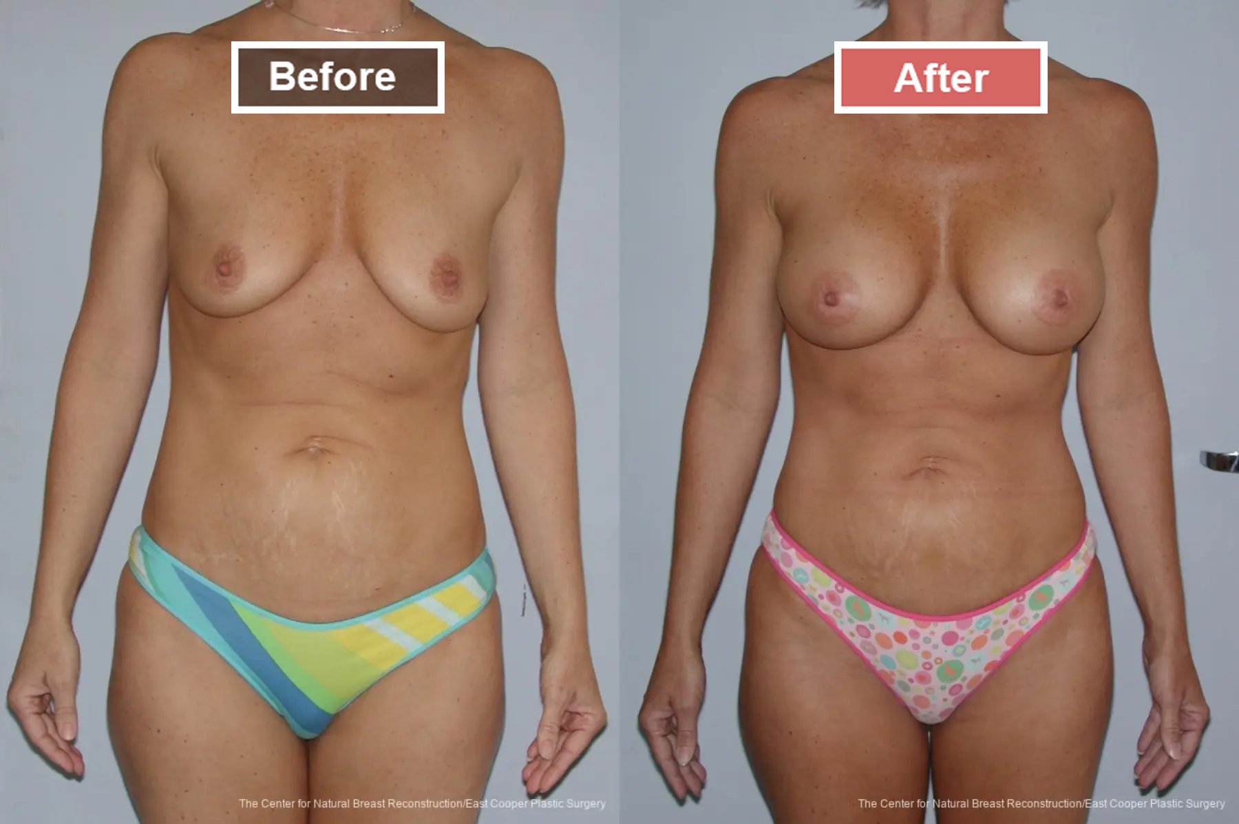 Breast Augmentation treatment before and after - 25