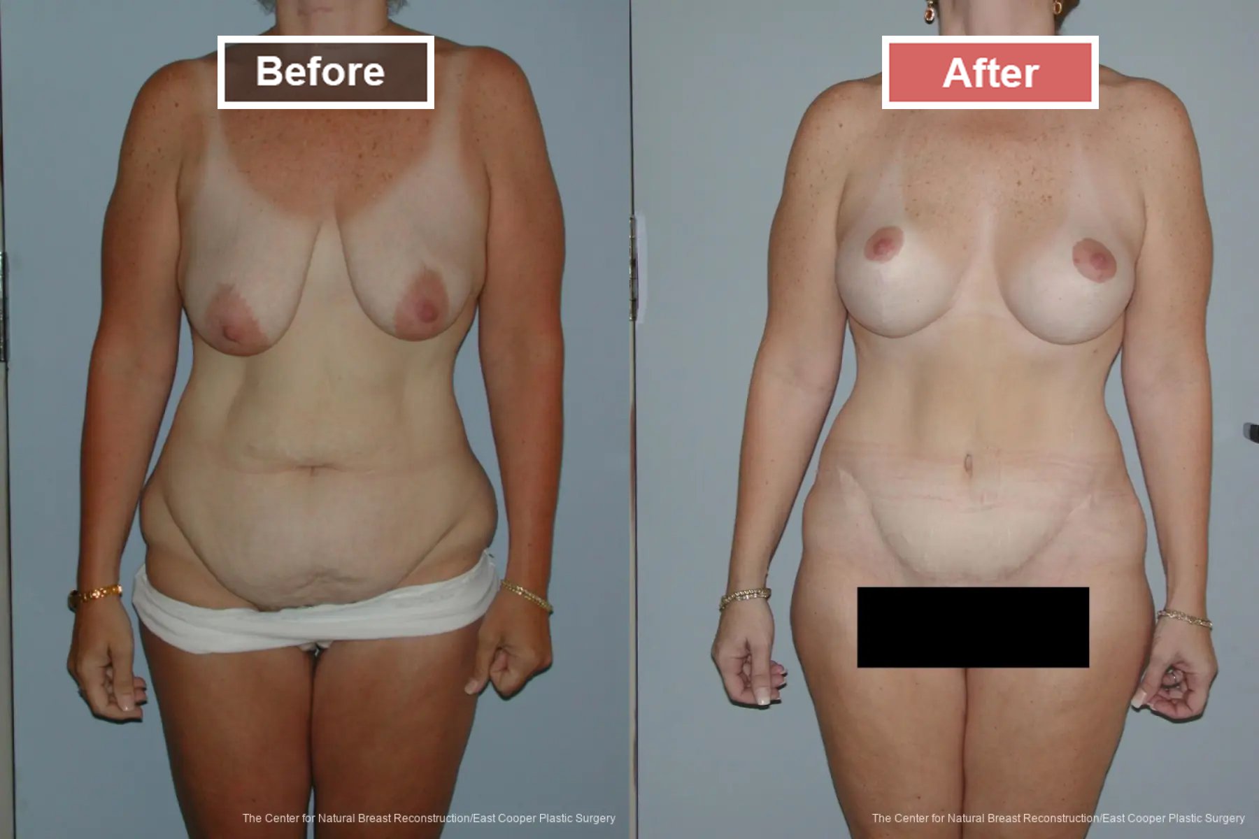 Breast Augmentation treatment before and after - 26