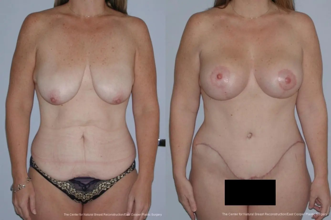 Breast Augmentation treatment before and after - 27
