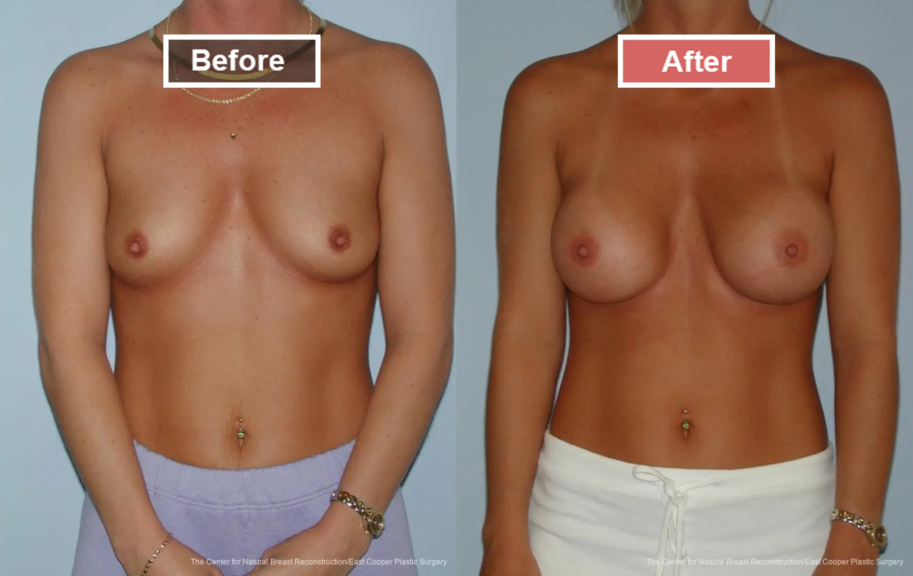 Breast Augmentation treatment before and after - 29