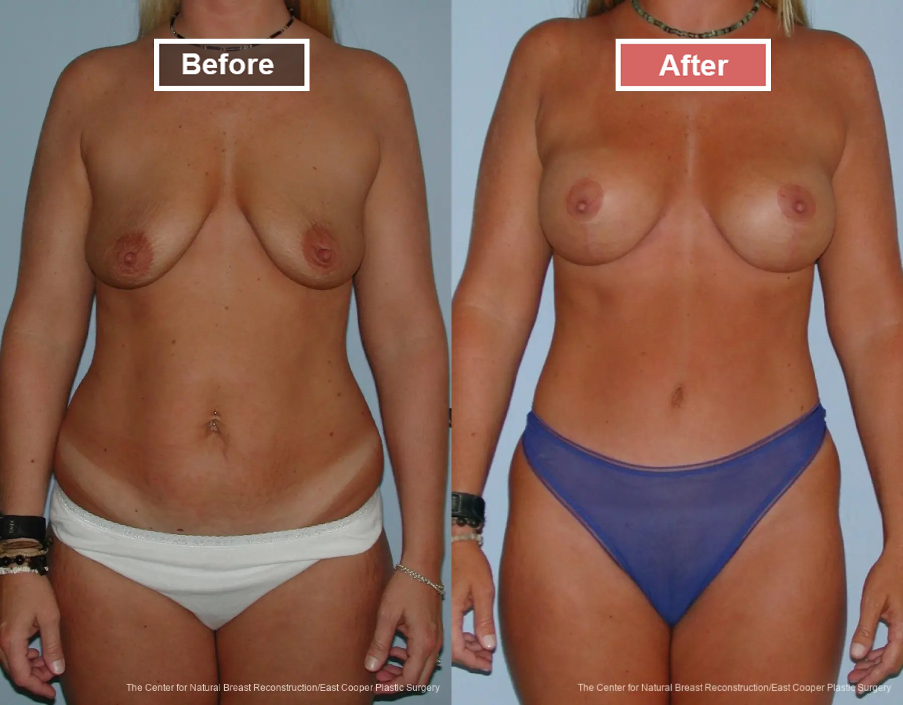 Breast Augmentation With Lift Before and After -1