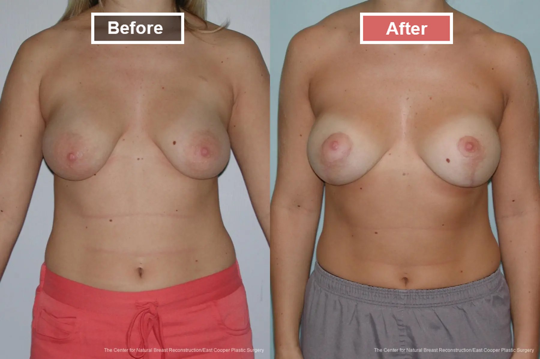 Breast Lift- Before and After -1