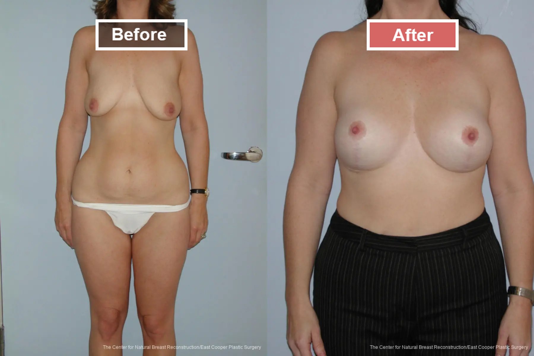 Breast Lift- Before and After -2