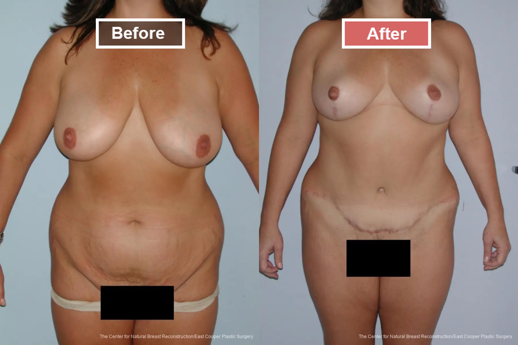 Breast Lift- Before and After -4