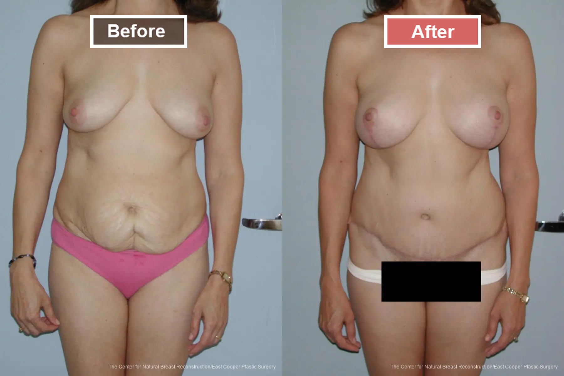 Breast Lift- Before and After -5