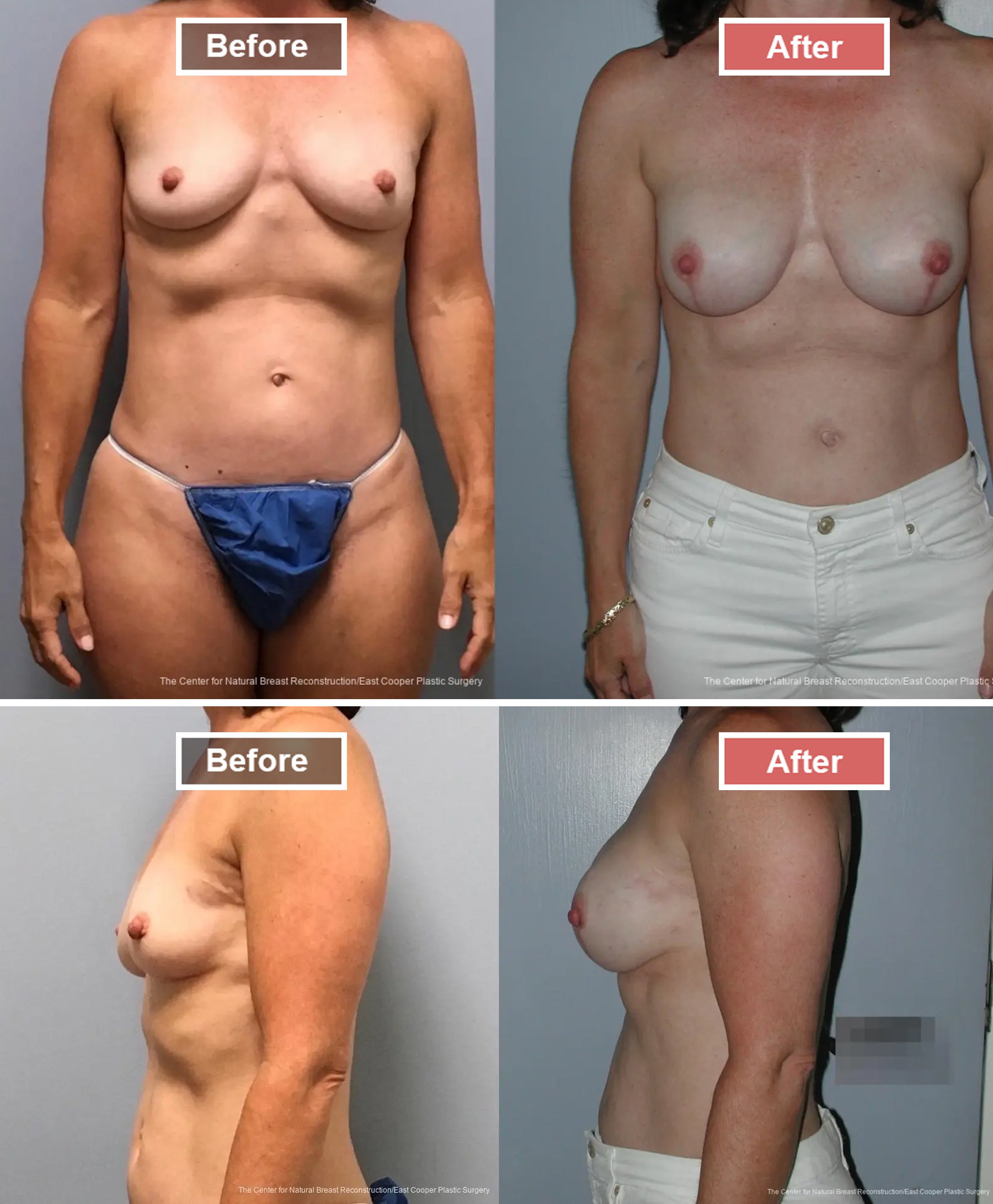 Breast Reconstruction - Before and After -1