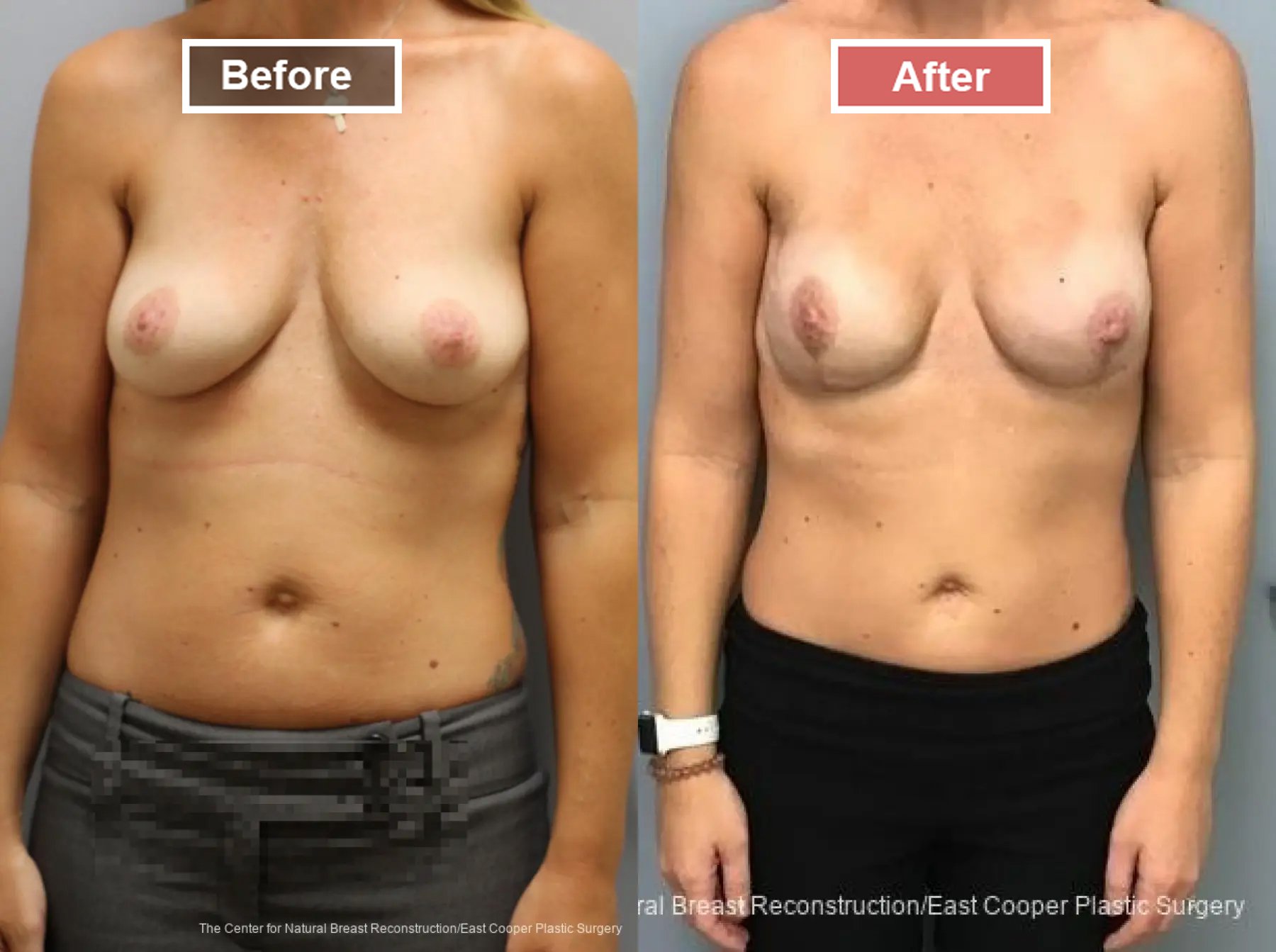 Breast Reconstruction- Before and After -2