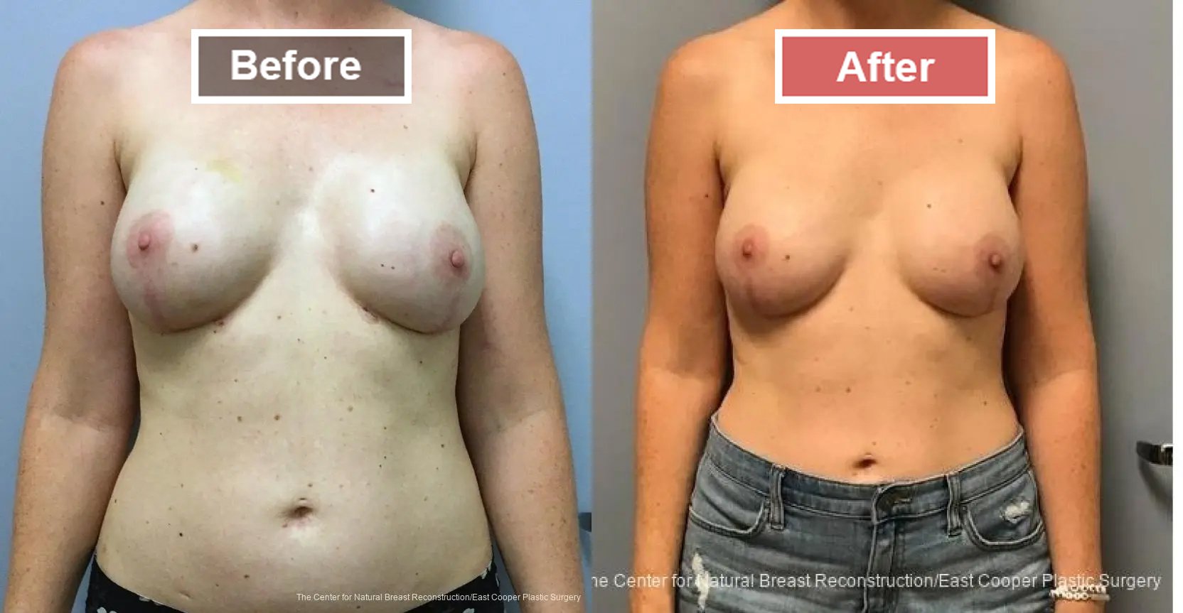 Breast Reconstruction- Before and After -5