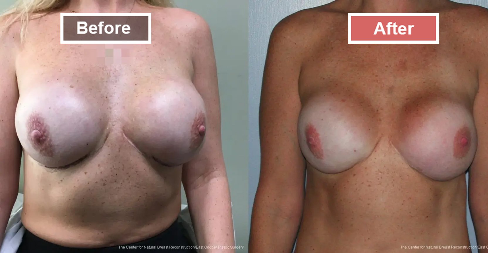 Breast Reconstruction- Before and After -5