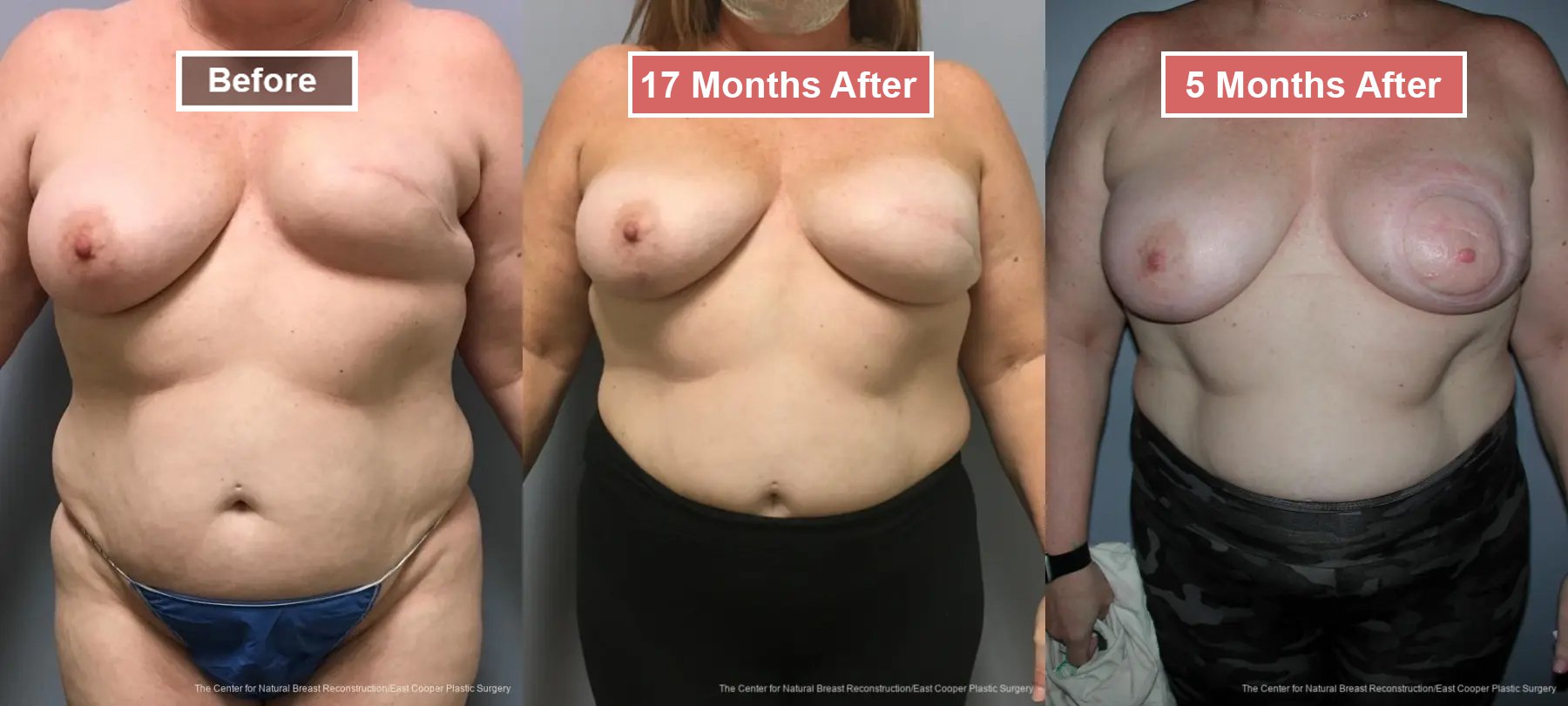 Breast Reconstruction- Before and After -6