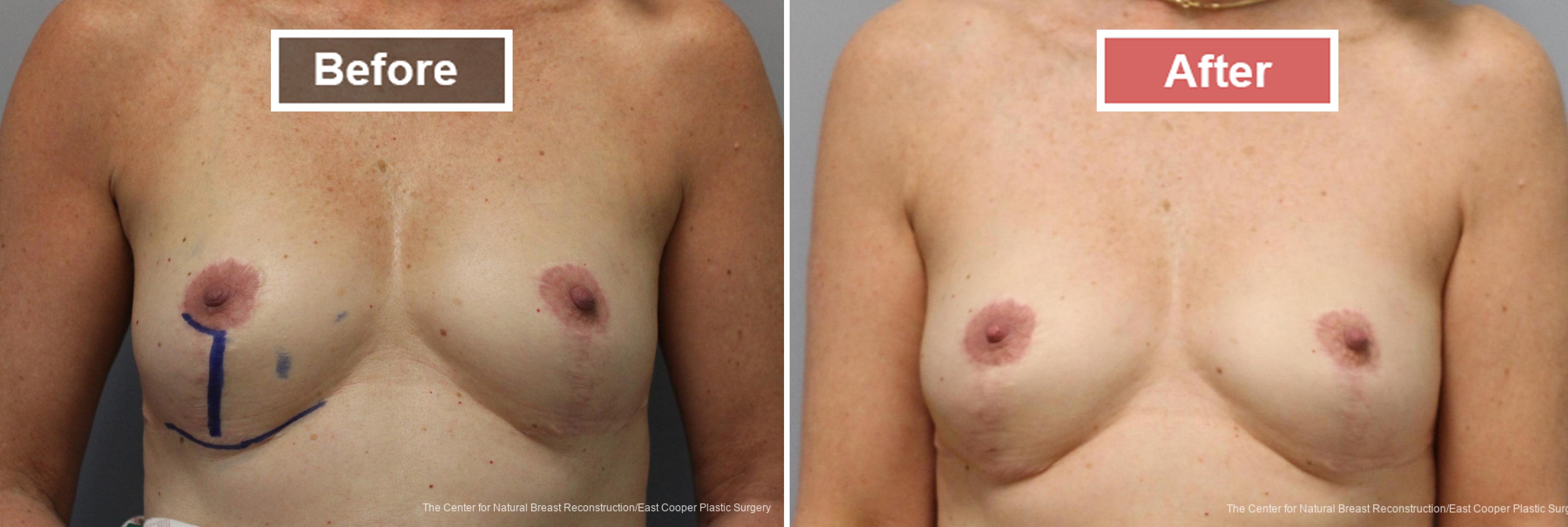Breast Reconstruction- Before and After -7