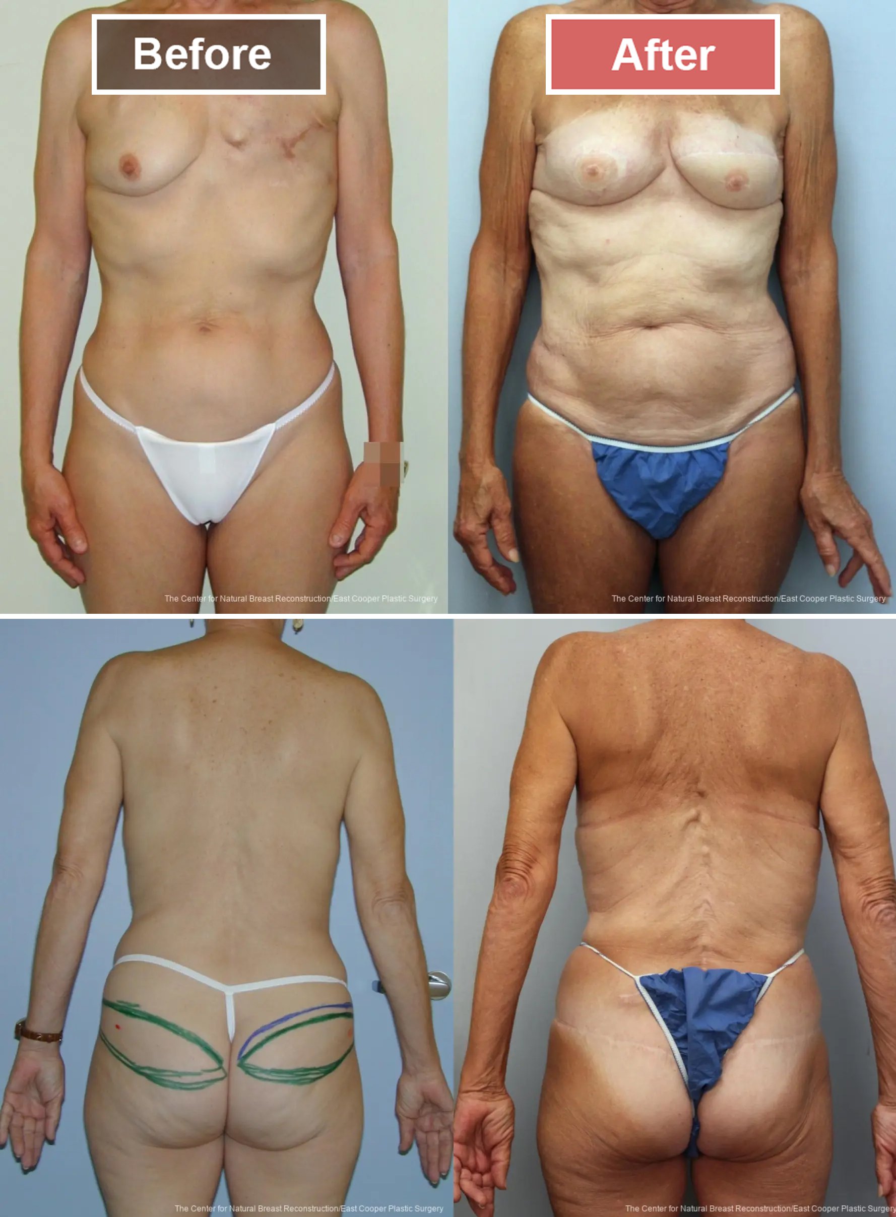 Breast Reconstruction GAP -1