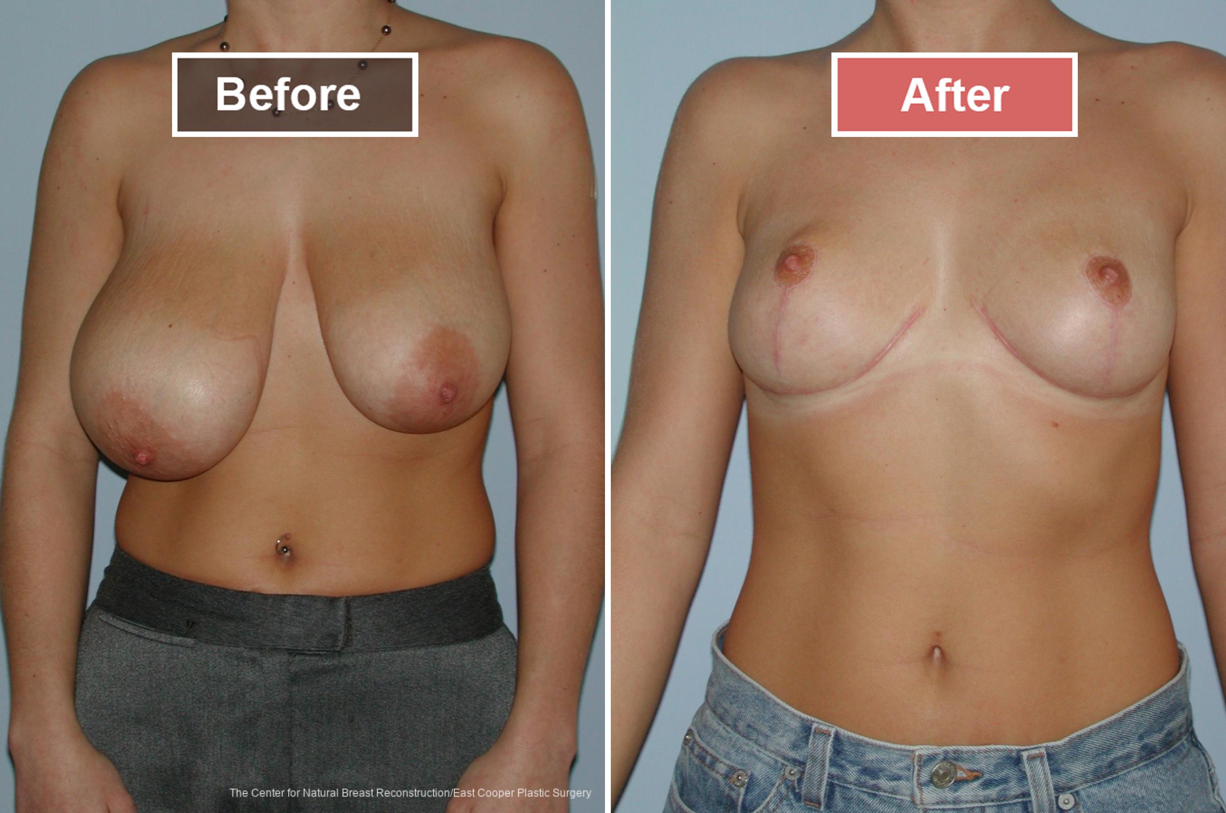 Breast Reduction Before and After -1