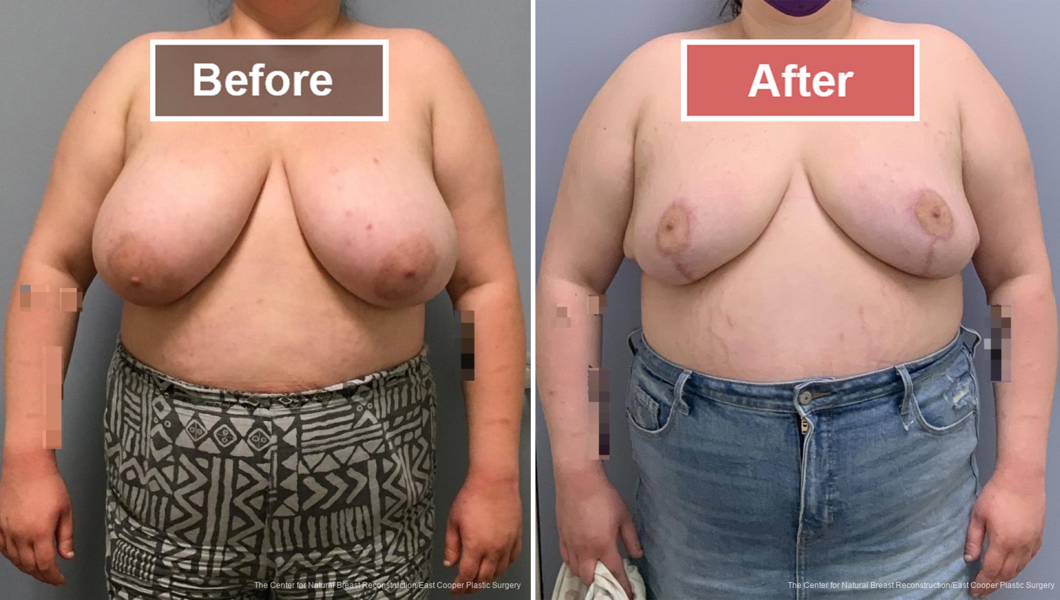 Breast Reduction Before and After -2