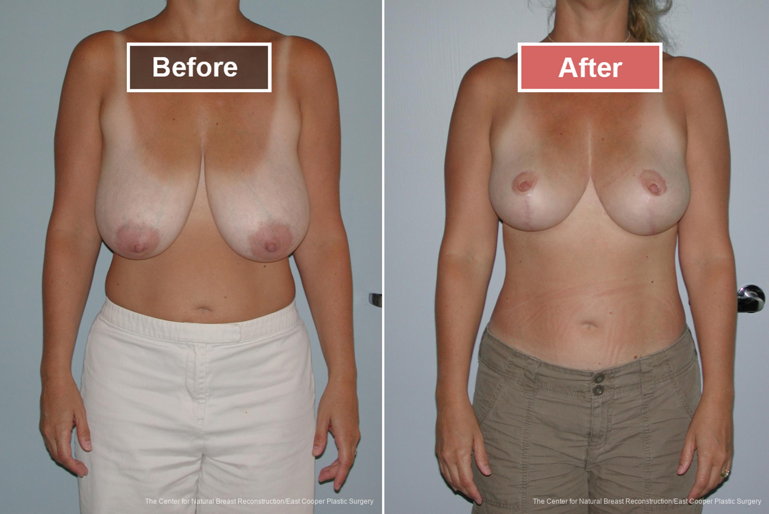 Breast Reduction Before and After -4