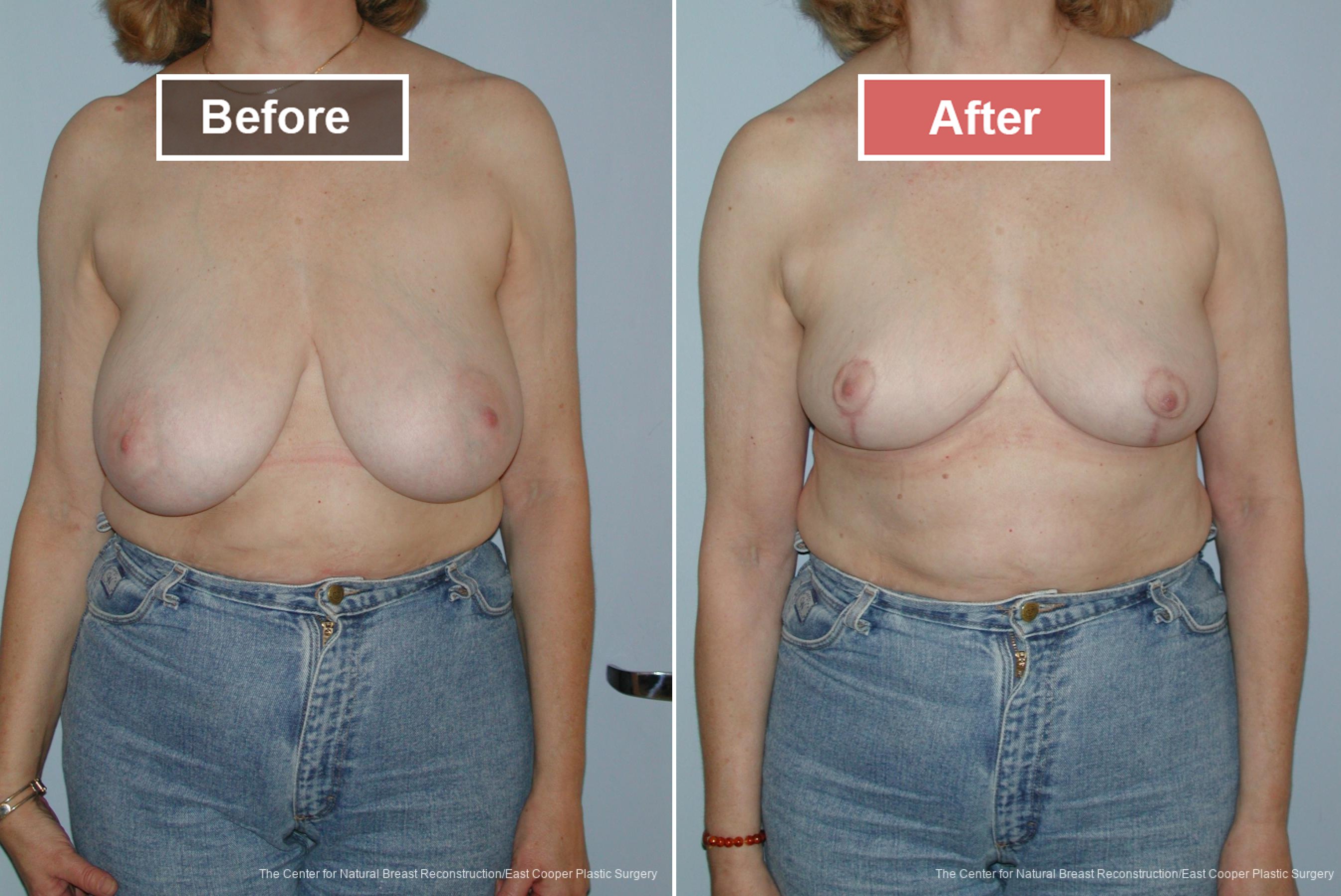 Breast Reduction Before and After -5