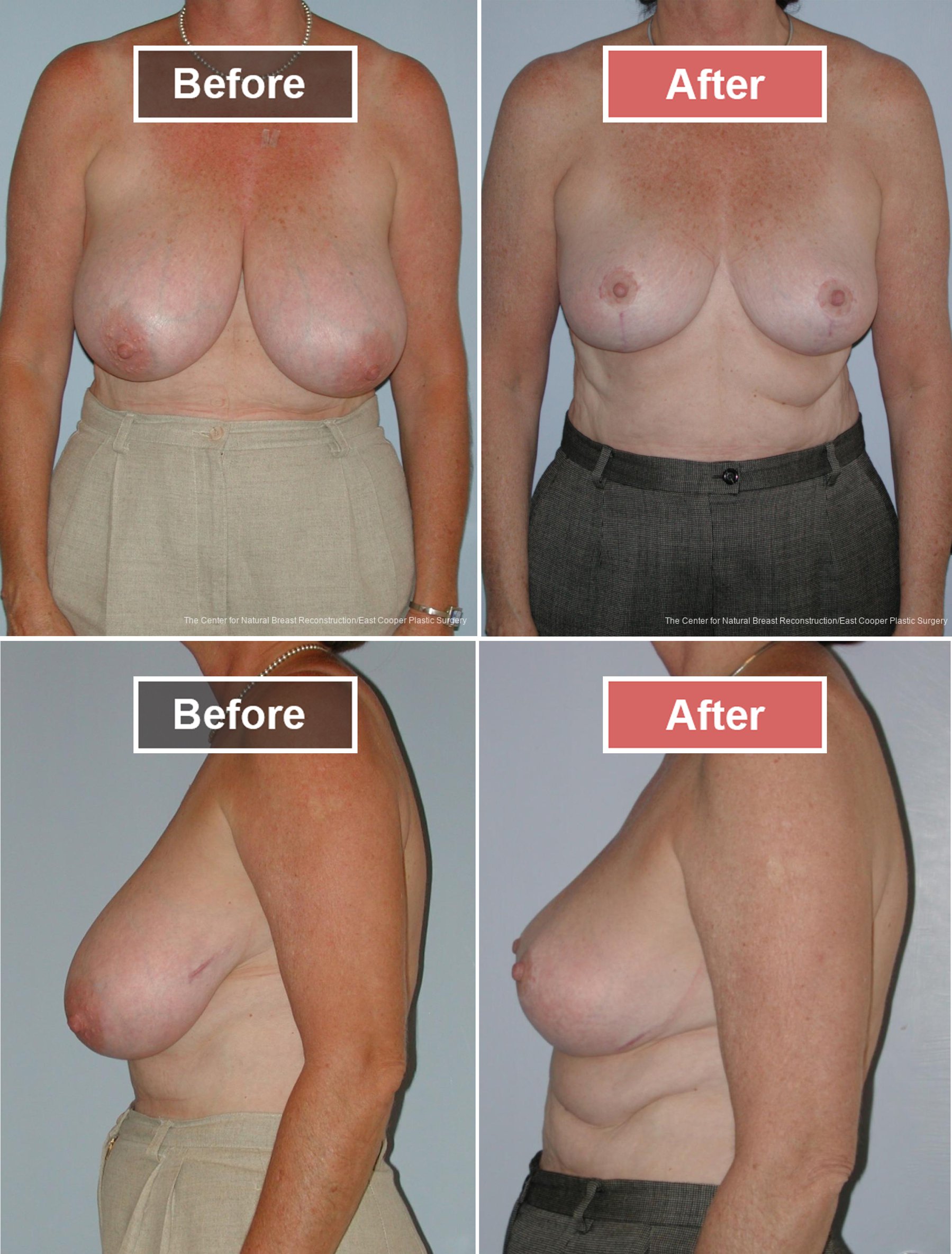 Breast Reduction Before and After -6