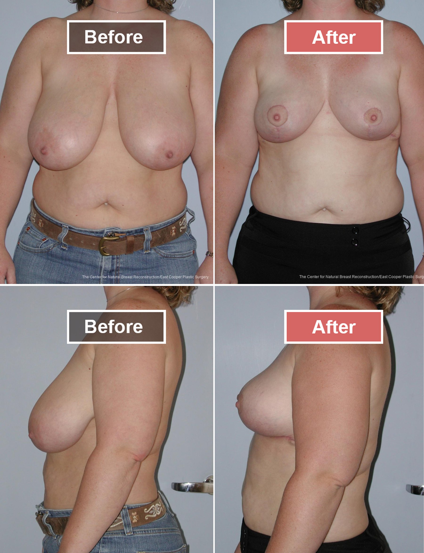 Breast Reduction Before and After -7