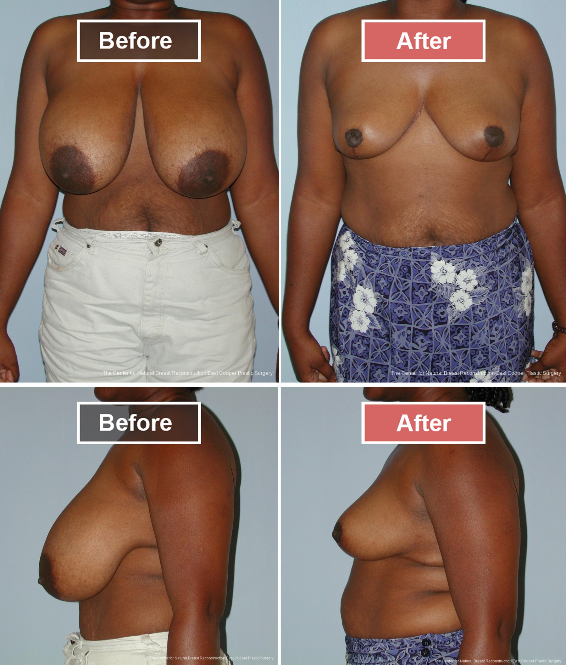 Breast Reduction Before and After -8