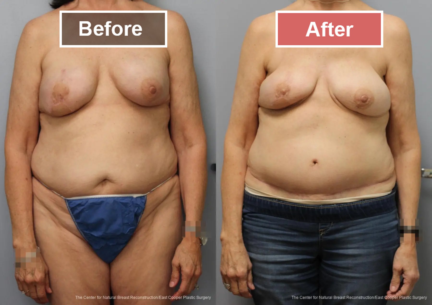 Breast Reconstruction DIEP- Before and After -40