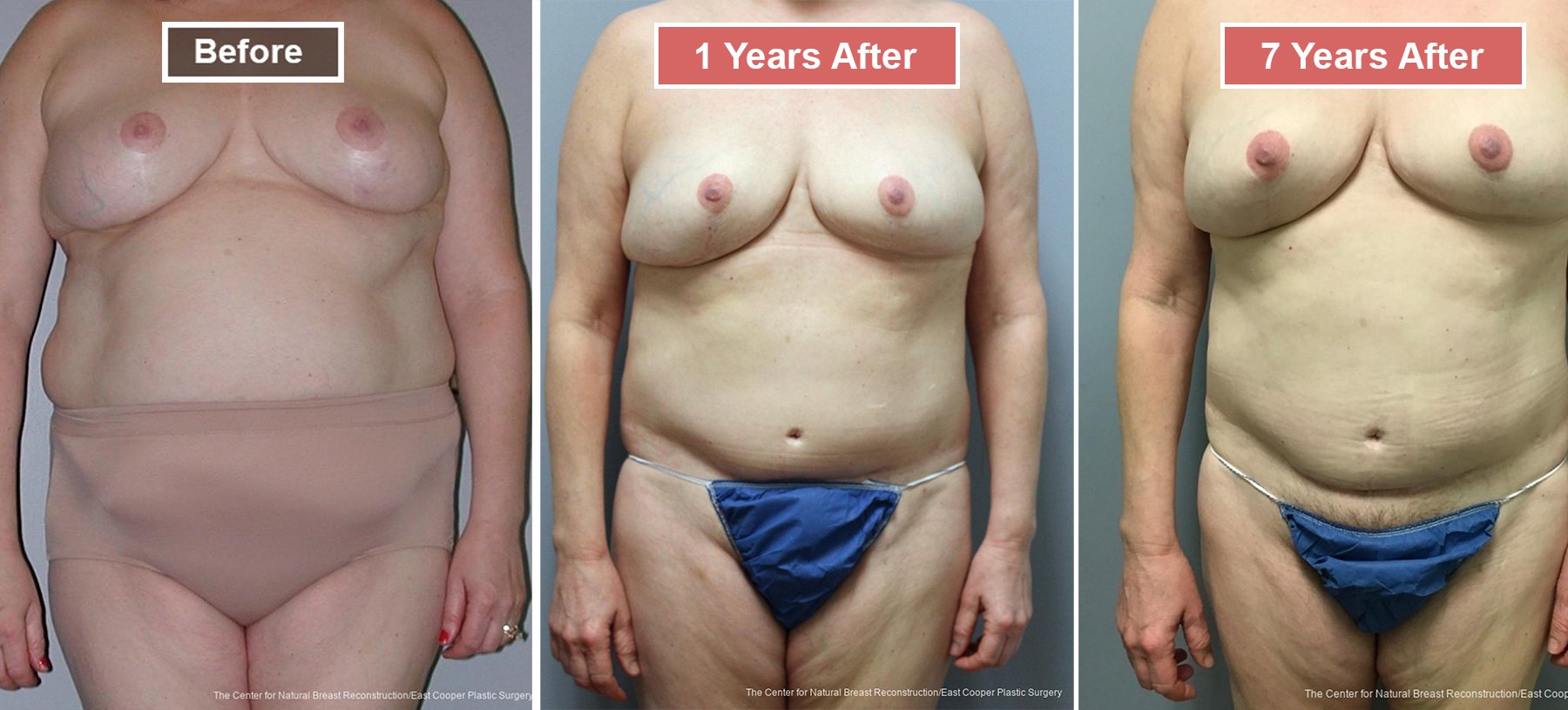 Breast Reconstruction DIEP- Before and After -41