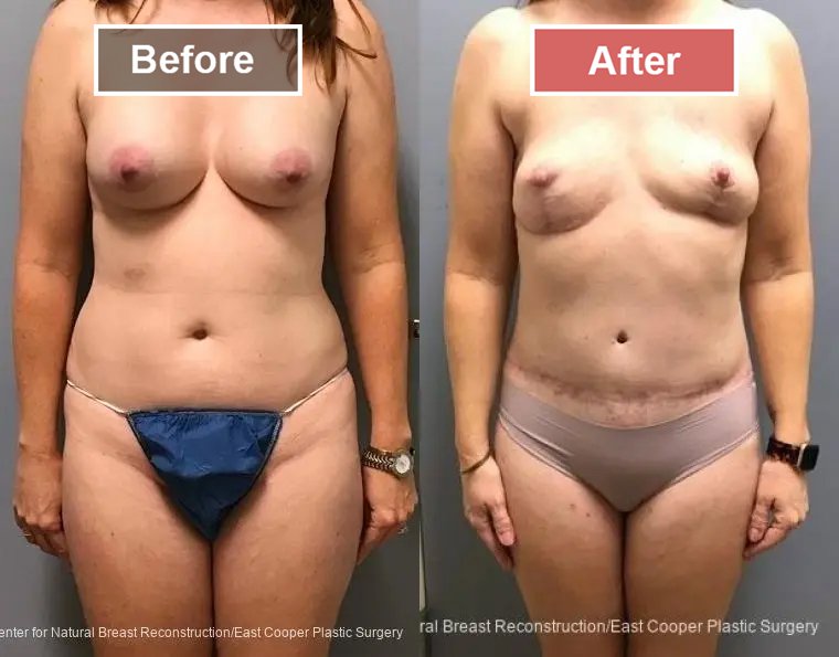 Breast Reconstruction DIEP- Before and After -41