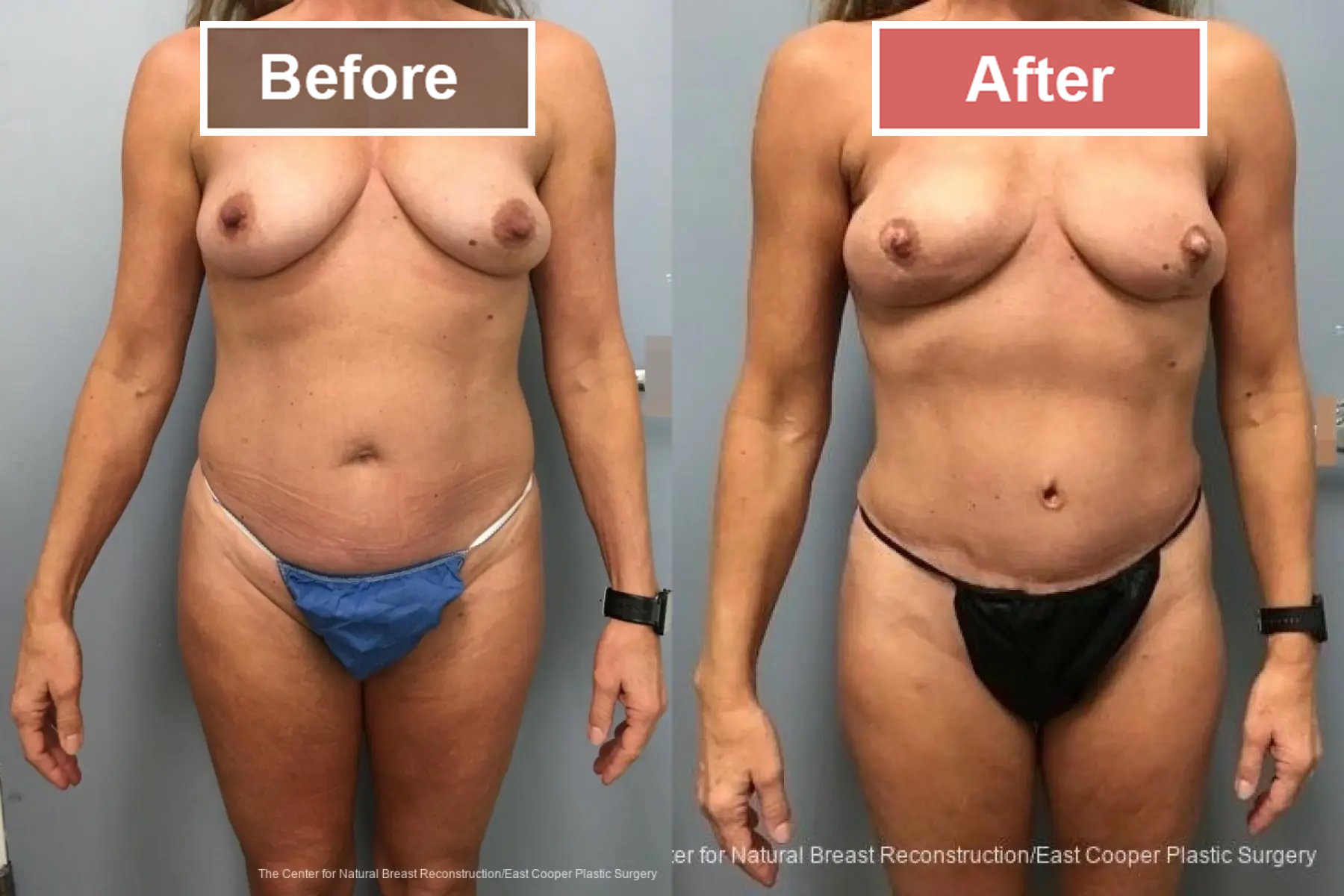 Breast Reconstruction DIEP- Before and After -41