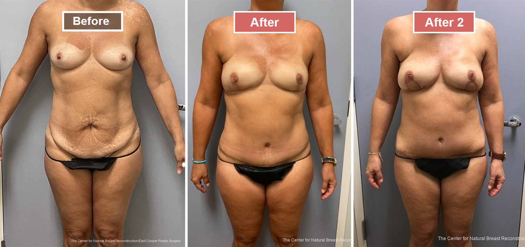 Breast Reconstruction DIEP- Before and After -41