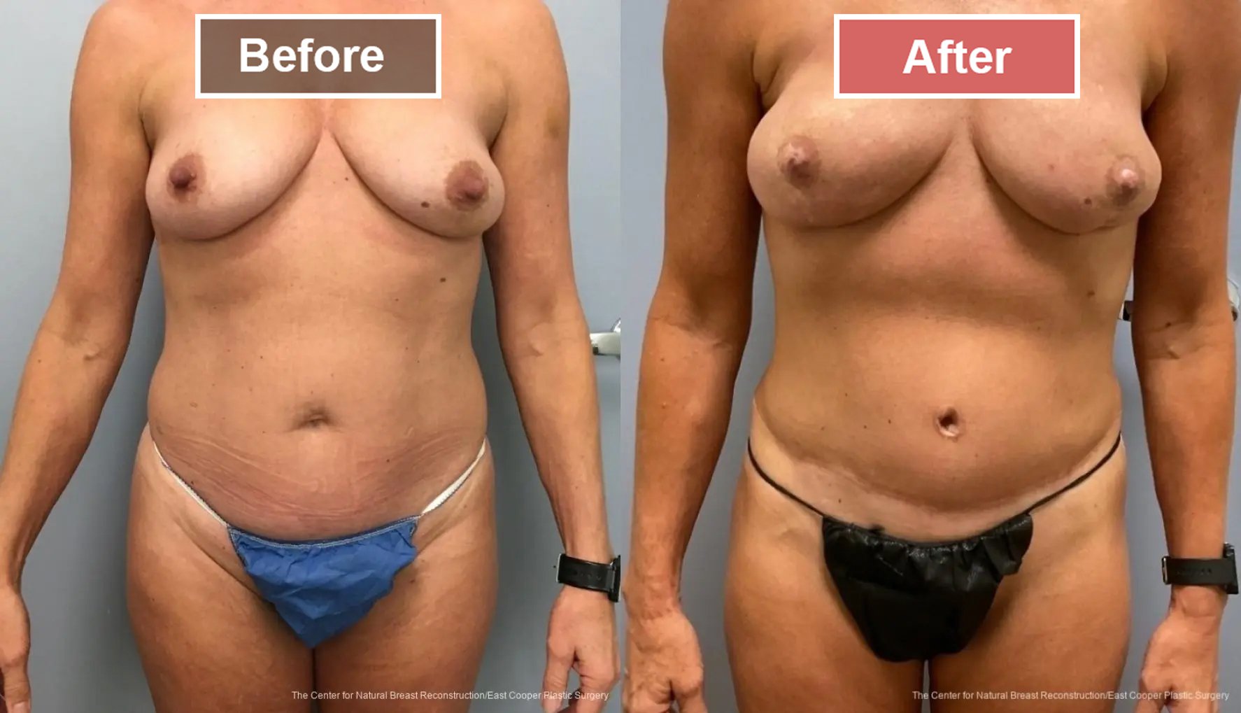 Breast Reconstruction DIEP- Before and After -41