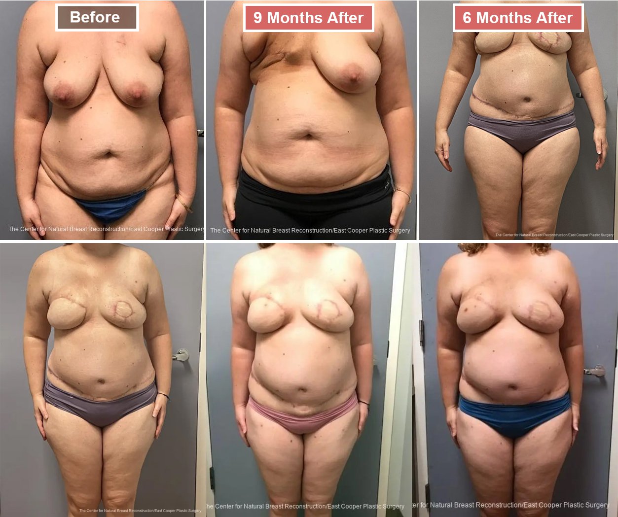 Breast Reconstruction DIEP- Before and After -41