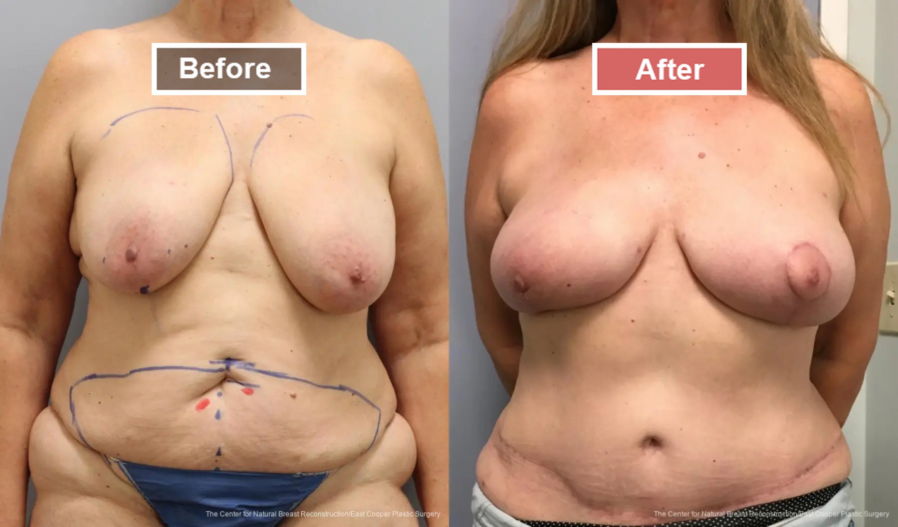 Breast Reconstruction DIEP - Before and After -1