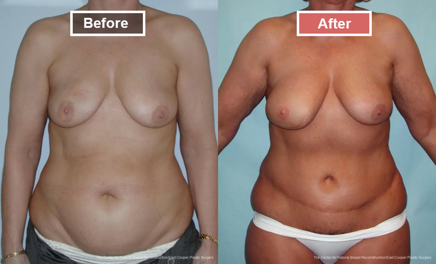 Breast Reconstruction DIEP- Before and After -2