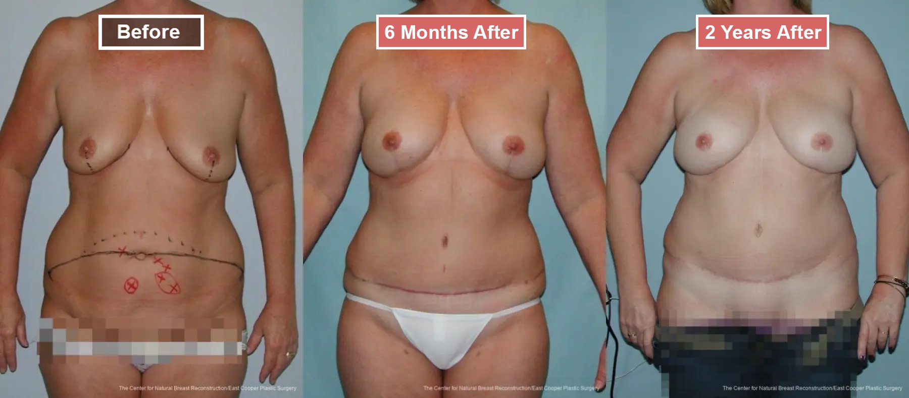 Breast Reconstruction DIEP- Before and After -3