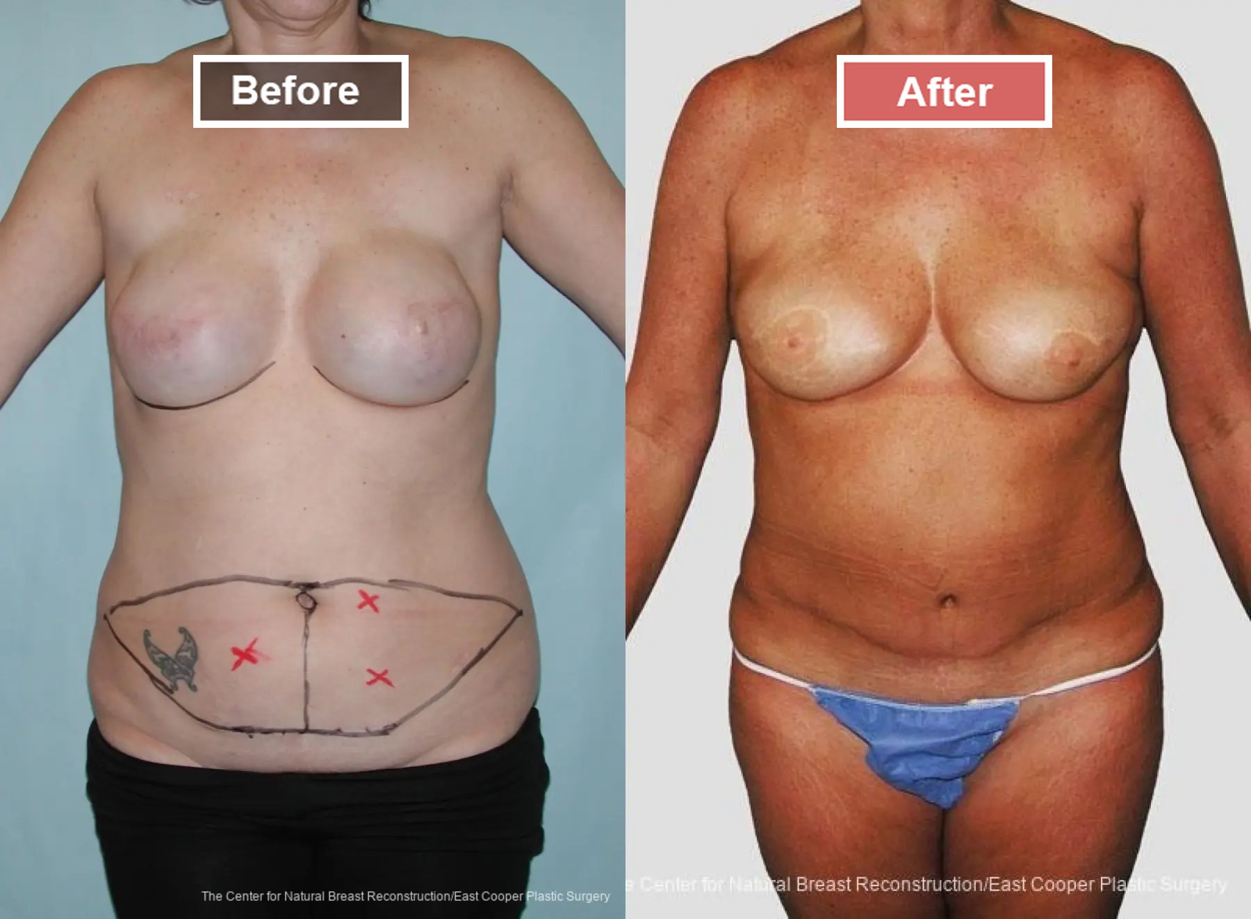 Breast Reconstruction DIEP- Before and After -4