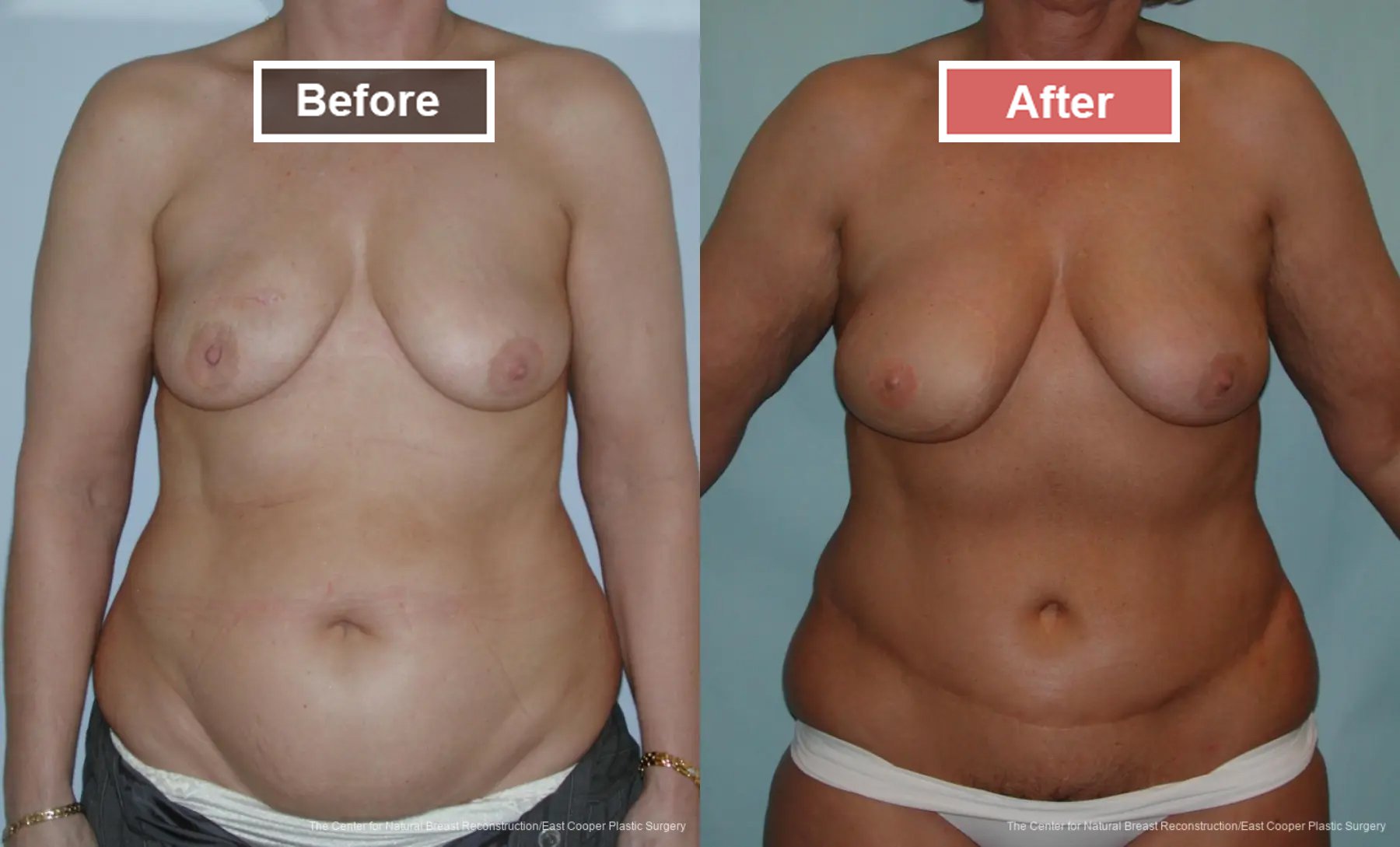 Breast Reconstruction DIEP- Before and After -7