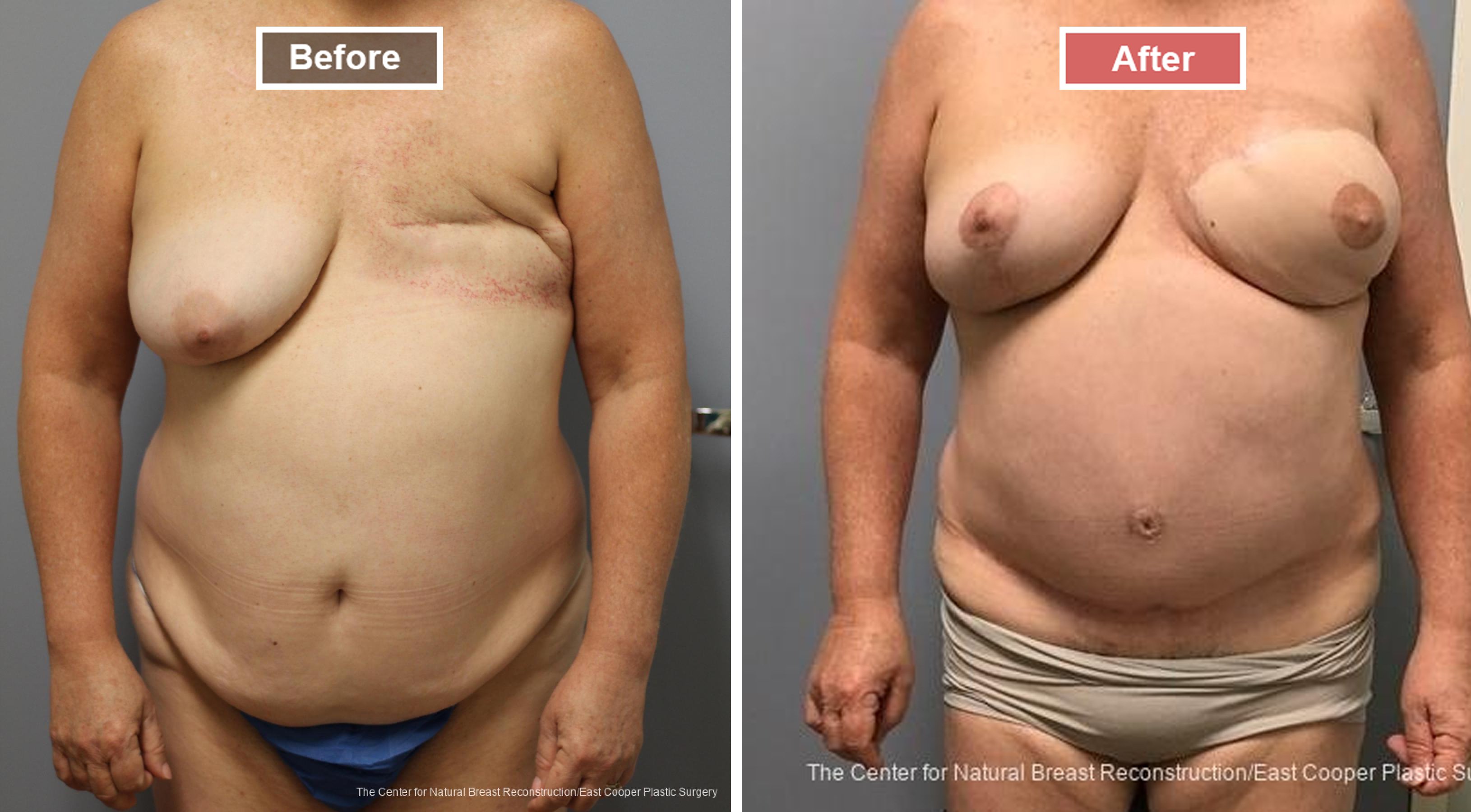 Breast Reconstruction DIEP- Before and After -8