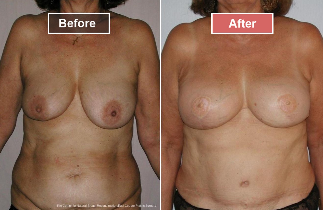 Breast Reconstruction DIEP- Before and After -8