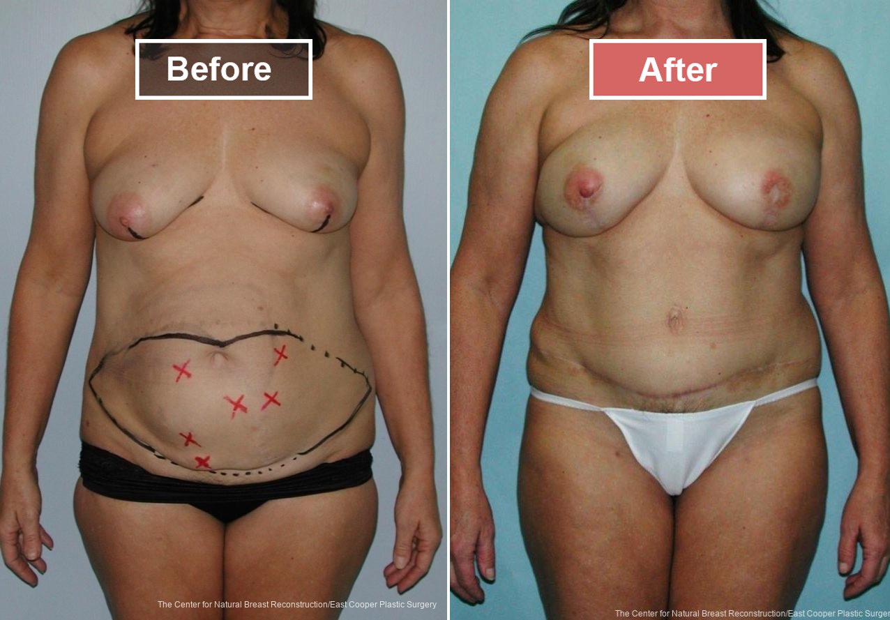 Breast Reconstruction DIEP- Before and After -9